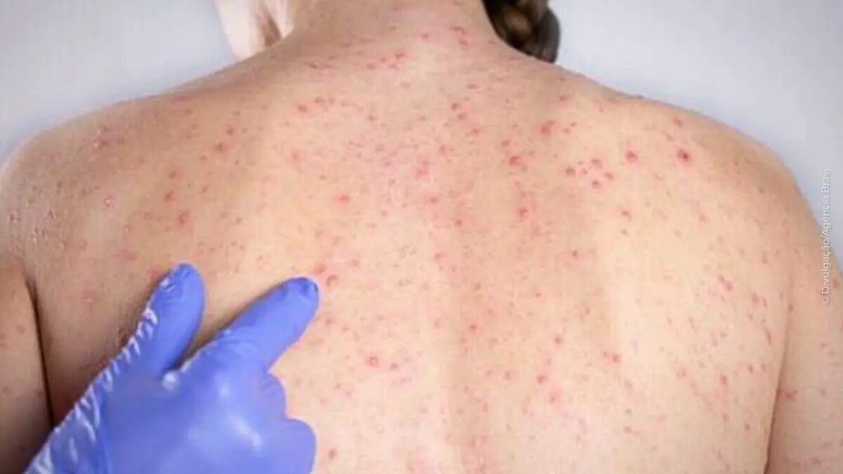 Nova York decreta estado de emergência após surto de sarampo